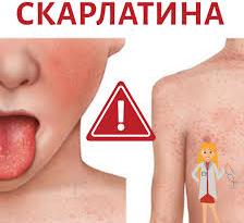Що таке скарлатина